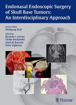Abbildung von Draf / Carrau | Endonasal Endoscopic Surgery of Skull Base Tumors: An Interdisciplinary Approach | 1. Auflage | 2015 | beck-shop.de