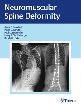 Abbildung von Samdani / Newton | Neuromuscular Spine Deformity | 1. Auflage | 2018 | beck-shop.de