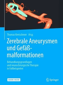Abbildung von Kretschmer | Zerebrale Aneurysmen und Gefäßmalformationen | 1. Auflage | 2017 | beck-shop.de
