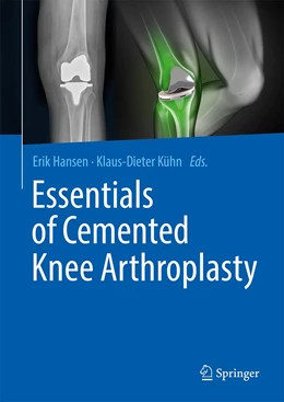 Abbildung von Hansen / Kühn | Essentials of Cemented Knee Arthroplasty | 1. Auflage | 2021 | beck-shop.de