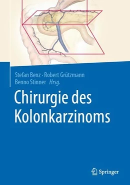 Abbildung von Benz / Grützmann | Chirurgie des Kolonkarzinoms | 1. Auflage | 2021 | beck-shop.de
