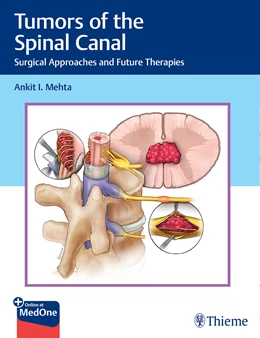 Abbildung von Mehta | Tumors of the Spinal Canal | 1. Auflage | 2022 | beck-shop.de