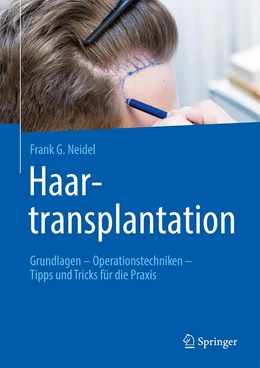 Abbildung von Neidel | Haartransplantation | 1. Auflage | 2022 | beck-shop.de